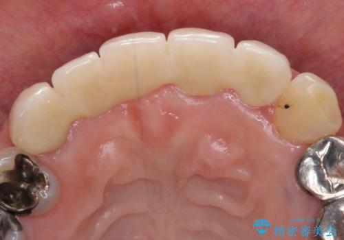 汚い仮歯で困っている 前歯のオールセラミックブリッジの治療後