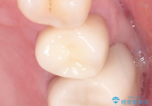 金属のかぶせ物をセラミックへ 根管治療からの再治療の治療後