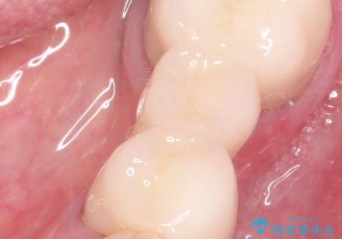 金属のかぶせ物をセラミックへ 根管治療からの再治療の治療後