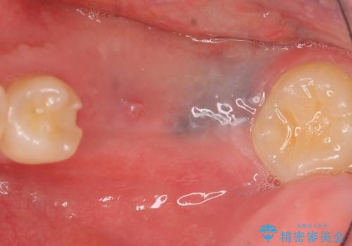 インプラント 失ってしまった奥歯の再建の症例 治療前