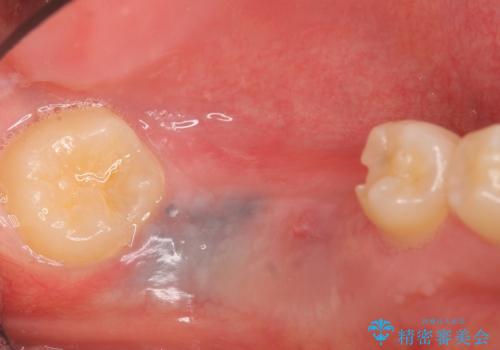 インプラント 失ってしまった奥歯の再建の治療前