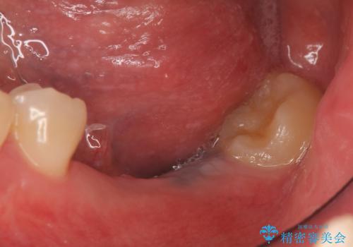 インプラント 失ってしまった奥歯の再建の治療前