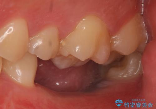 インプラント 失ってしまった奥歯の再建の治療前
