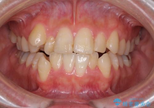 上下の八重歯を治したい インビザラインと補助装置を用いた抜歯治療の症例 治療前