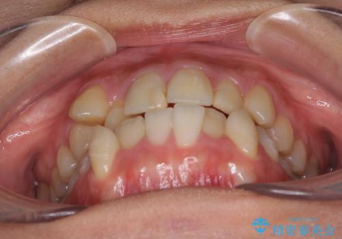 上下の八重歯を治したい インビザラインと補助装置を用いた抜歯治療の治療前