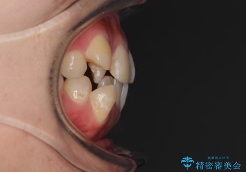 上下の八重歯を治したい インビザラインと補助装置を用いた抜歯治療の治療前