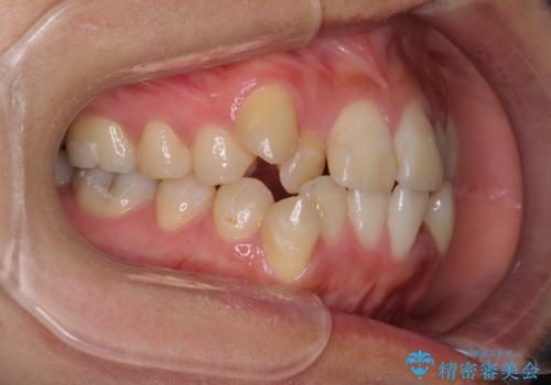 上下の八重歯を治したい インビザラインと補助装置を用いた抜歯治療の治療前