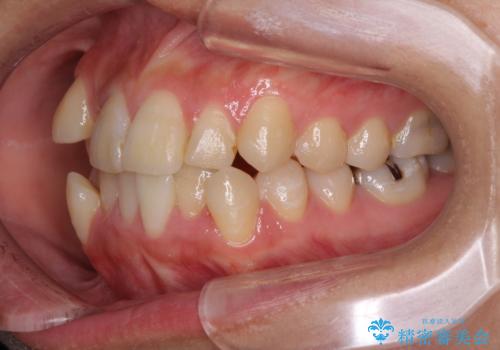 上下の八重歯を治したい インビザラインと補助装置を用いた抜歯治療の治療前