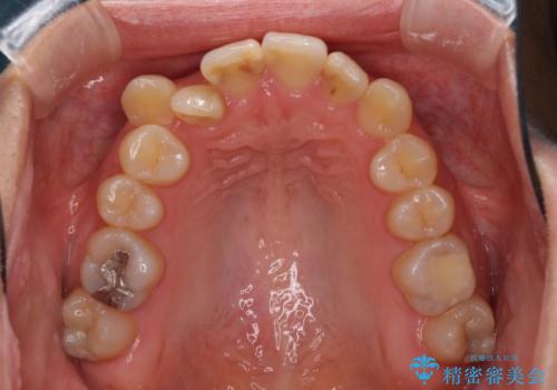 上下の八重歯を治したい インビザラインと補助装置を用いた抜歯治療の治療前