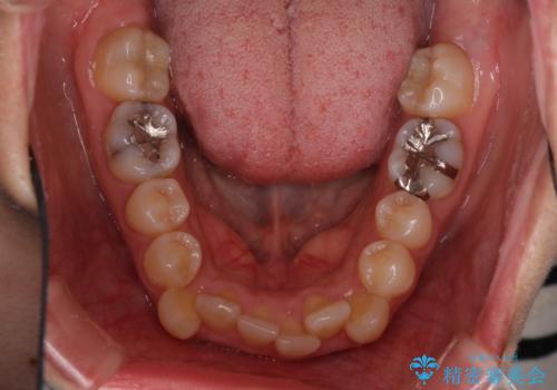 上下の八重歯を治したい　インビザラインと補助装置を用いた抜歯治療の治療前