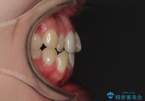 前歯のクロスバイトを治したい インビザラインによる矯正治療の治療前