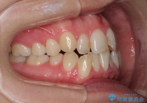 前歯のクロスバイトを治したい インビザラインによる矯正治療の治療前