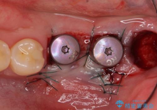 インプラント 失ってしまった奥歯の再建の治療後