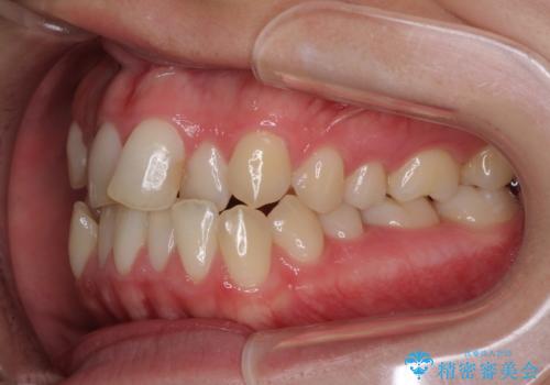前歯のクロスバイトを治したい インビザラインによる矯正治療の治療前