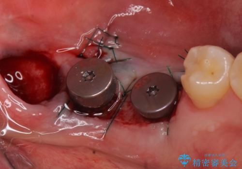 インプラント 失ってしまった奥歯の再建の治療後