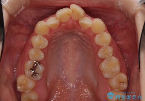 前歯のクロスバイトを治したい インビザラインによる矯正治療の治療前