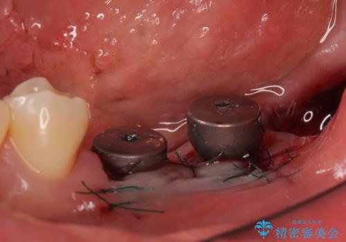 インプラント 失ってしまった奥歯の再建の治療後