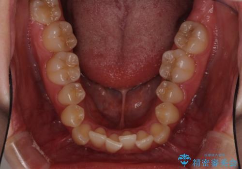 前歯のクロスバイトを治したい インビザラインによる矯正治療の治療前