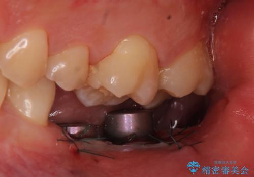 インプラント 失ってしまった奥歯の再建の治療後