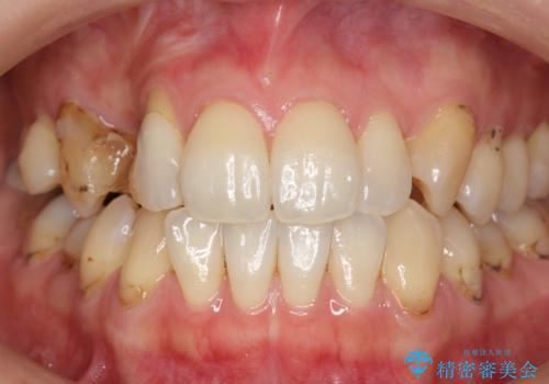 前歯の虫歯 とりあえずつけていた歯がとれたの症例 治療前
