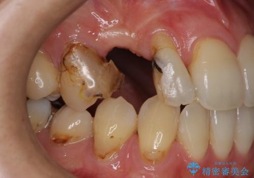 前歯の虫歯 とりあえずつけていた歯がとれたの治療前