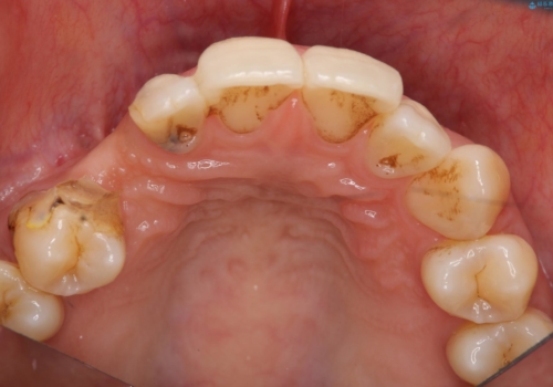 前歯の虫歯　とりあえずつけていた歯がとれたの治療前