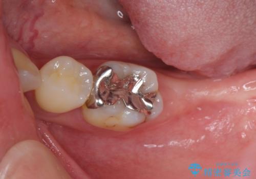 歯周病で抜歯に　奥歯のインプラント治療の治療中