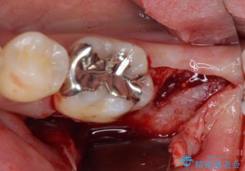 歯周病で抜歯に 奥歯のインプラント治療の治療後