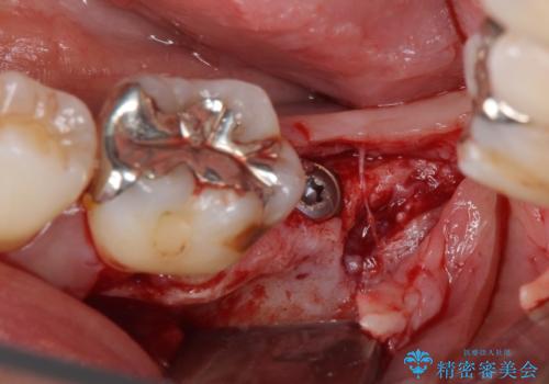 歯周病で抜歯に 奥歯のインプラント治療の治療前