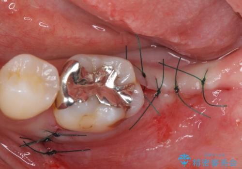 歯周病で抜歯に 奥歯のインプラント治療の治療中