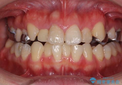 狭い上顎骨を拡大 インビザラインによる非抜歯矯正の治療中