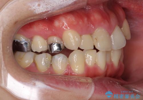 狭い上顎骨を拡大 インビザラインによる非抜歯矯正の治療中