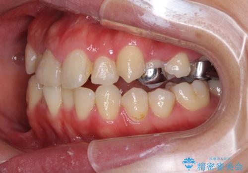 狭い上顎骨を拡大 インビザラインによる非抜歯矯正の治療中