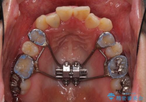 狭い上顎骨を拡大 インビザラインによる非抜歯矯正の治療中