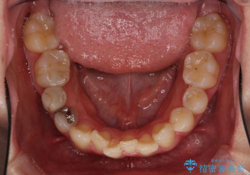 狭い上顎骨を拡大　インビザラインによる非抜歯矯正の治療中