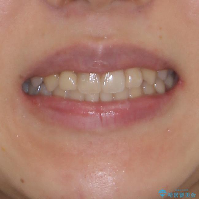 狭い上顎骨を拡大 インビザラインによる非抜歯矯正の治療後(顔貌)