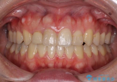 狭い上顎骨を拡大　インビザラインによる非抜歯矯正の治療後