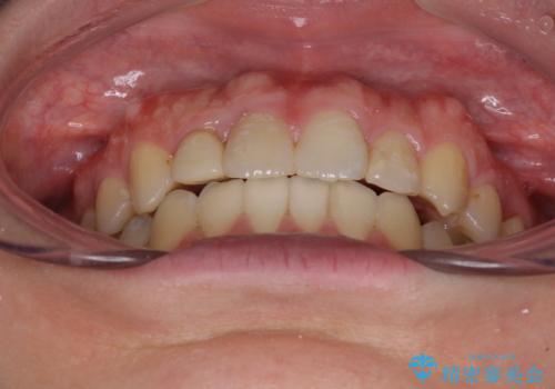 狭い上顎骨を拡大 インビザラインによる非抜歯矯正の治療後