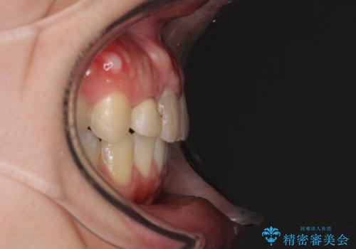 狭い上顎骨を拡大 インビザラインによる非抜歯矯正の治療後