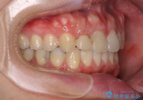 狭い上顎骨を拡大　インビザラインによる非抜歯矯正の治療後