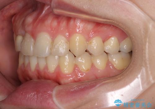 狭い上顎骨を拡大 インビザラインによる非抜歯矯正の治療後