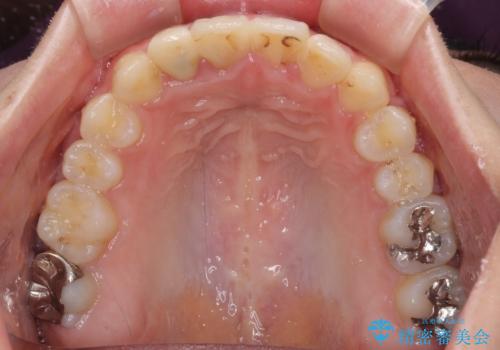 狭い上顎骨を拡大 インビザラインによる非抜歯矯正の治療後