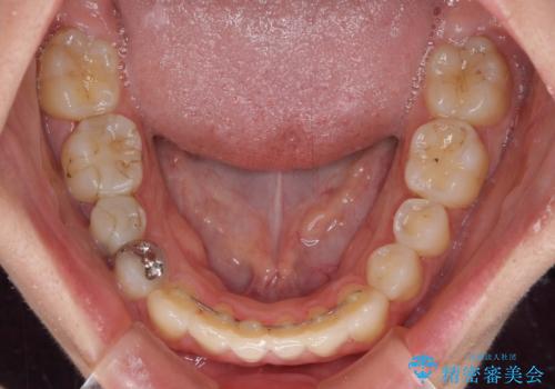 狭い上顎骨を拡大 インビザラインによる非抜歯矯正の治療後