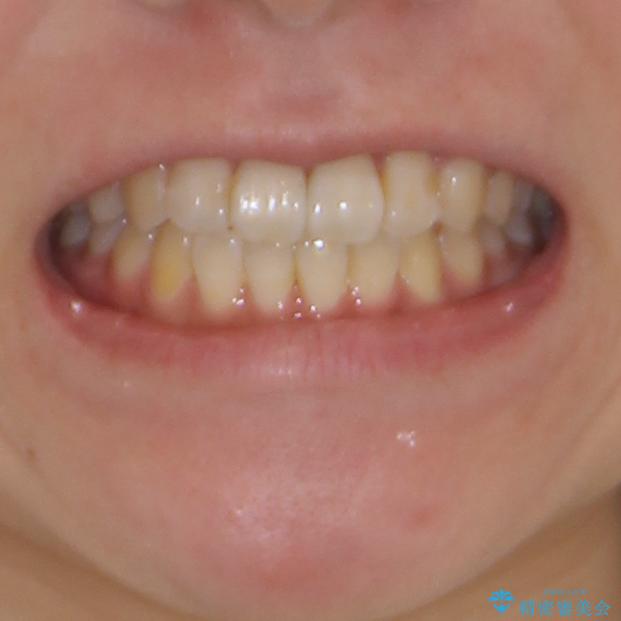 気になる前歯のデコボコ　インビザラインによる矯正治療の治療後（顔貌）