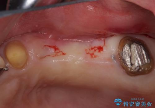 ブリッジの土台が割れて痛い インプラントによる補綴治療の治療前