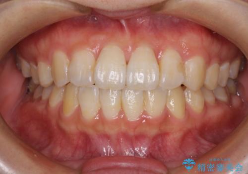 気になる前歯のデコボコ インビザラインによる矯正治療の症例 治療後