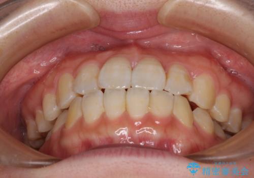 気になる前歯のデコボコ　インビザラインによる矯正治療の治療後