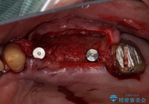 ブリッジの土台が割れて痛い インプラントによる補綴治療の治療中