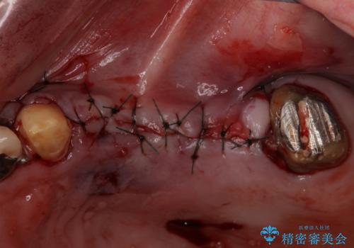 ブリッジの土台が割れて痛い インプラントによる補綴治療の治療後