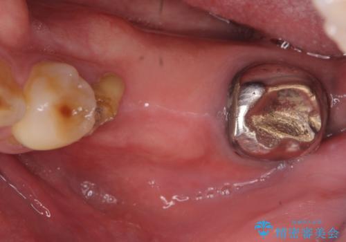 インプラント　失った奥歯の欠損補綴の症例 治療前